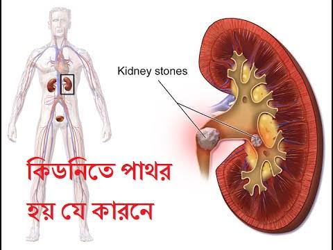 কিডনিতে পাথর হওয়ার কারণ, লক্ষণ ও সমাধান