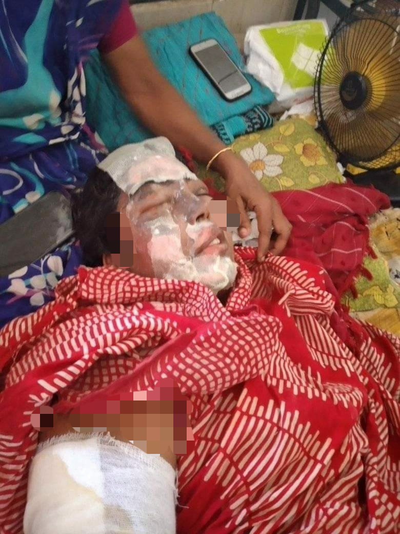 সন্দ্বীপে বসতঘরে আগুনঃ ২জন আহত
