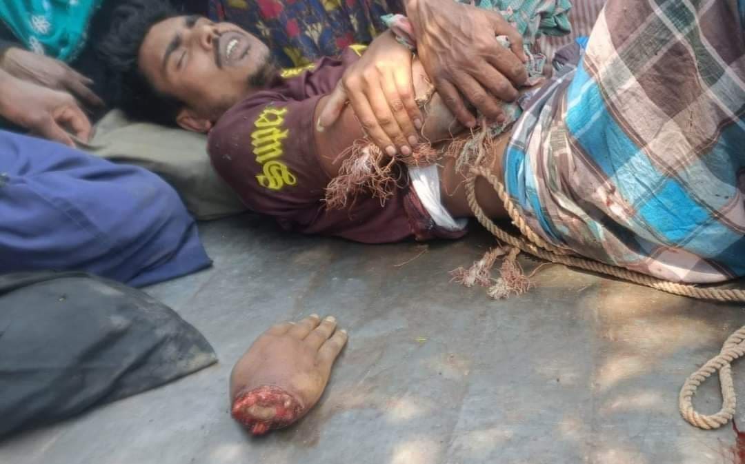 শিবগঞ্জে মামানির সঙ্গে প্রেম, তুলে নিয়ে গিয়ে যুবকের হাতের কব্জি দ্বিখণ্ডিত